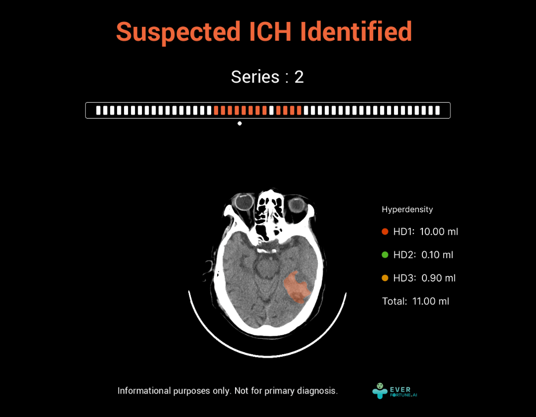 腦出血檢測系統