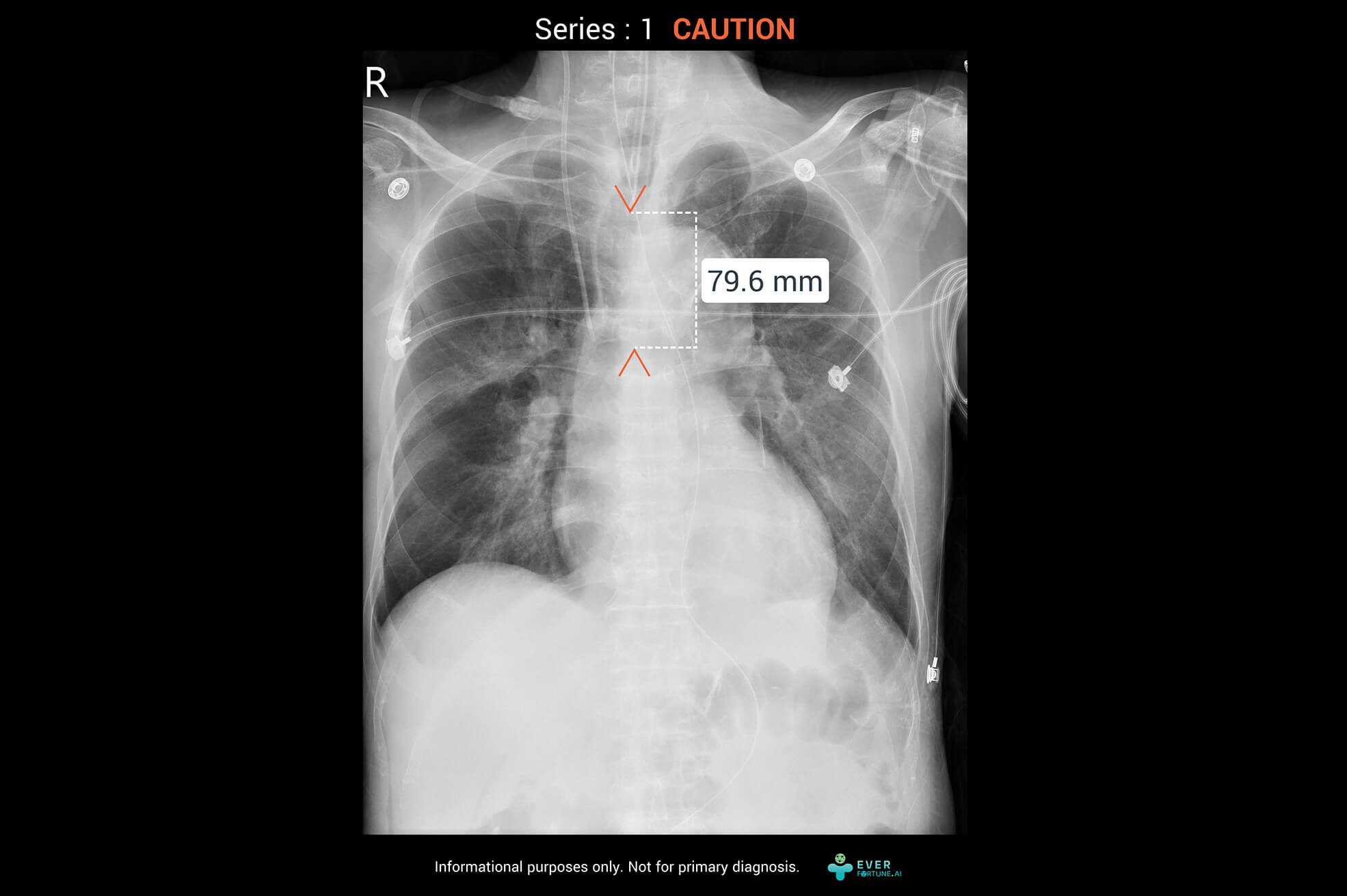 產品示意圖-更換圖檔-CXR-4-ETT