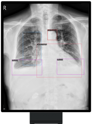 CXR_CASE 2 CXR_CASE 2