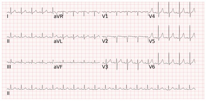 Sinus tachycardia竇性心律過快