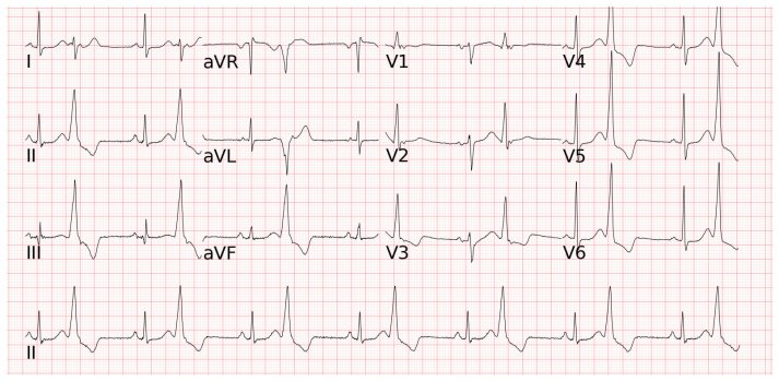 Ventricular Bigeminy 單純雙聯律心跳特徵
