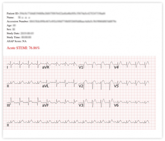 有STEMI (備註)即刻通知急診室醫師 1