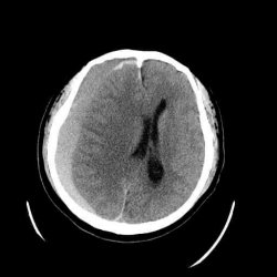 Intracranial Hemorrhage, ICH 顱內出血(Intracranial Hemorrhage, ICH)